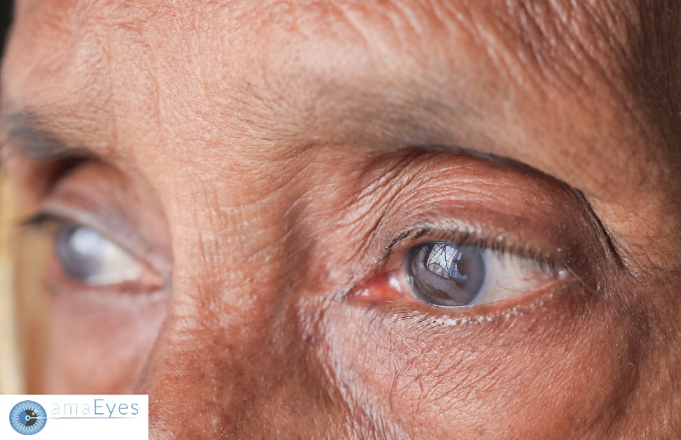 Cloudy eye lens showing cataracts within the lens center.